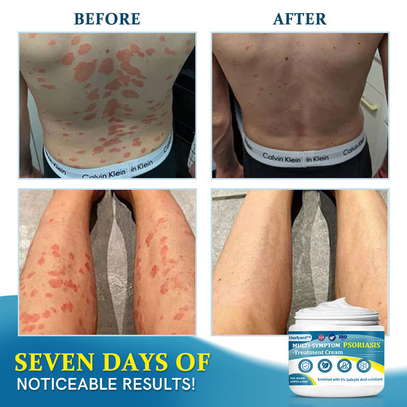 ✅EMA-Certified Ourlyard™ Advanced Multi-Symptom Psoriasis Treatment Cream👨⚕️Dermatologist Approved🔥75% OFF
