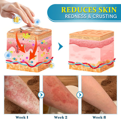 ✅EMA-Certified Ourlyard™ Advanced Multi-Symptom Psoriasis Treatment Cream👨‍⚕️Dermatologist Approved🔥75% OFF