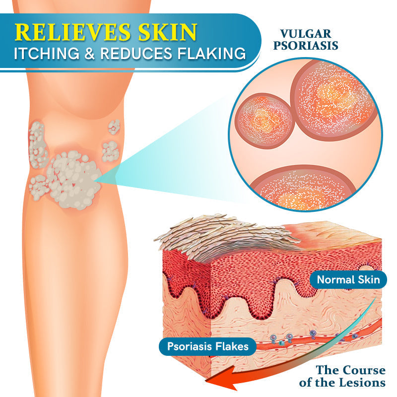 ✅EMA-Certified Ourlyard™ Advanced Multi-Symptom Psoriasis Treatment Cream👨‍⚕️Dermatologist Approved🔥75% OFF